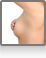 Breast Augmentation Montreal - Breast Reduction
